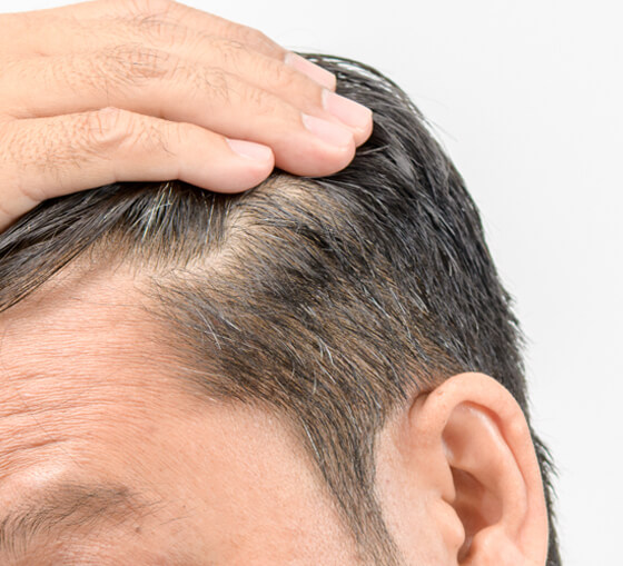 Tratamientos para el cabello