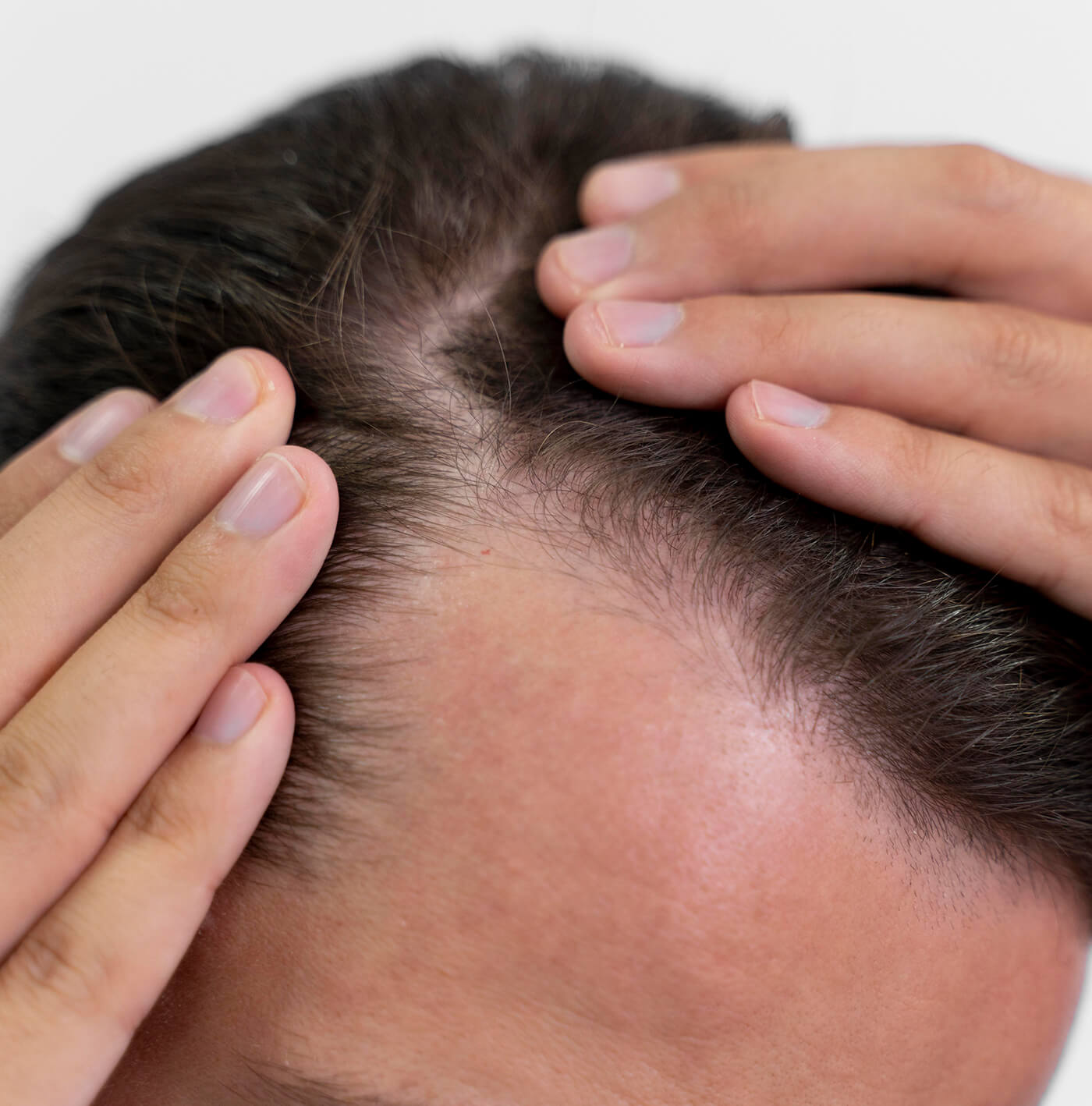 Alopecias (pérdida de cabello)