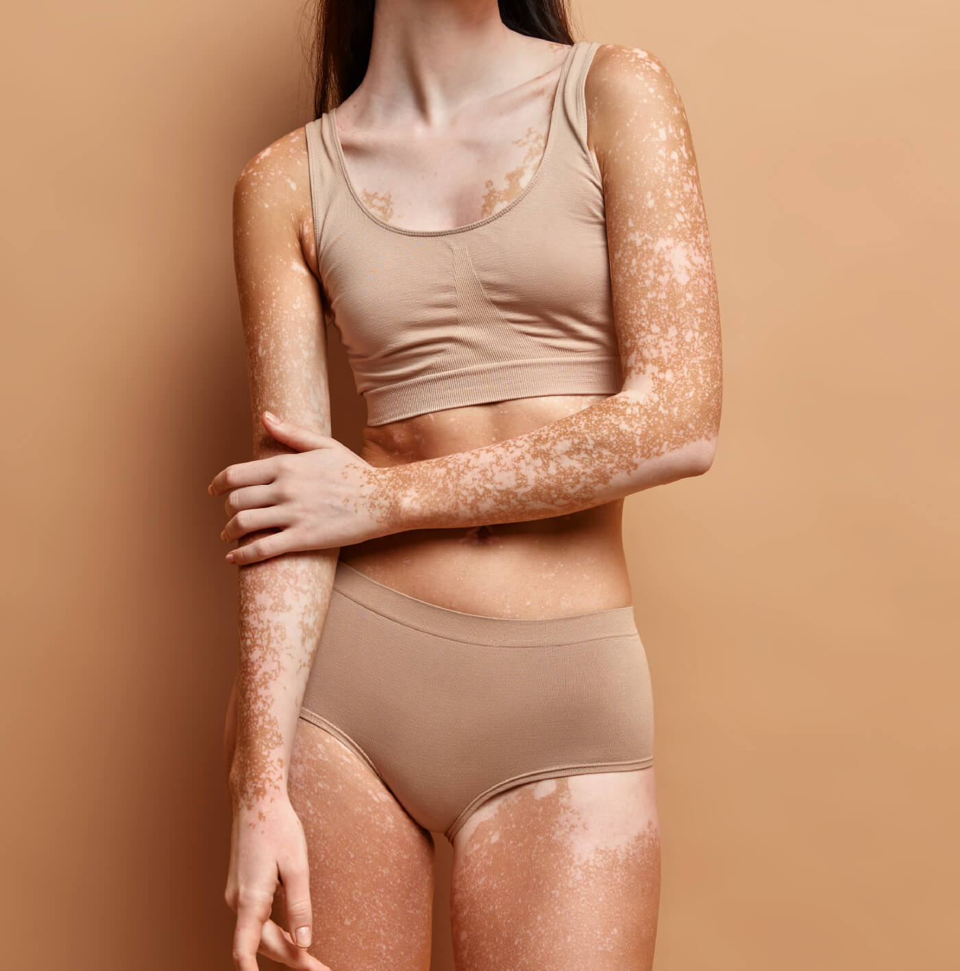 Vitiligo