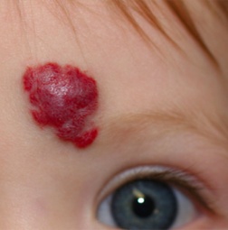 Tratamiento de hemangiomas