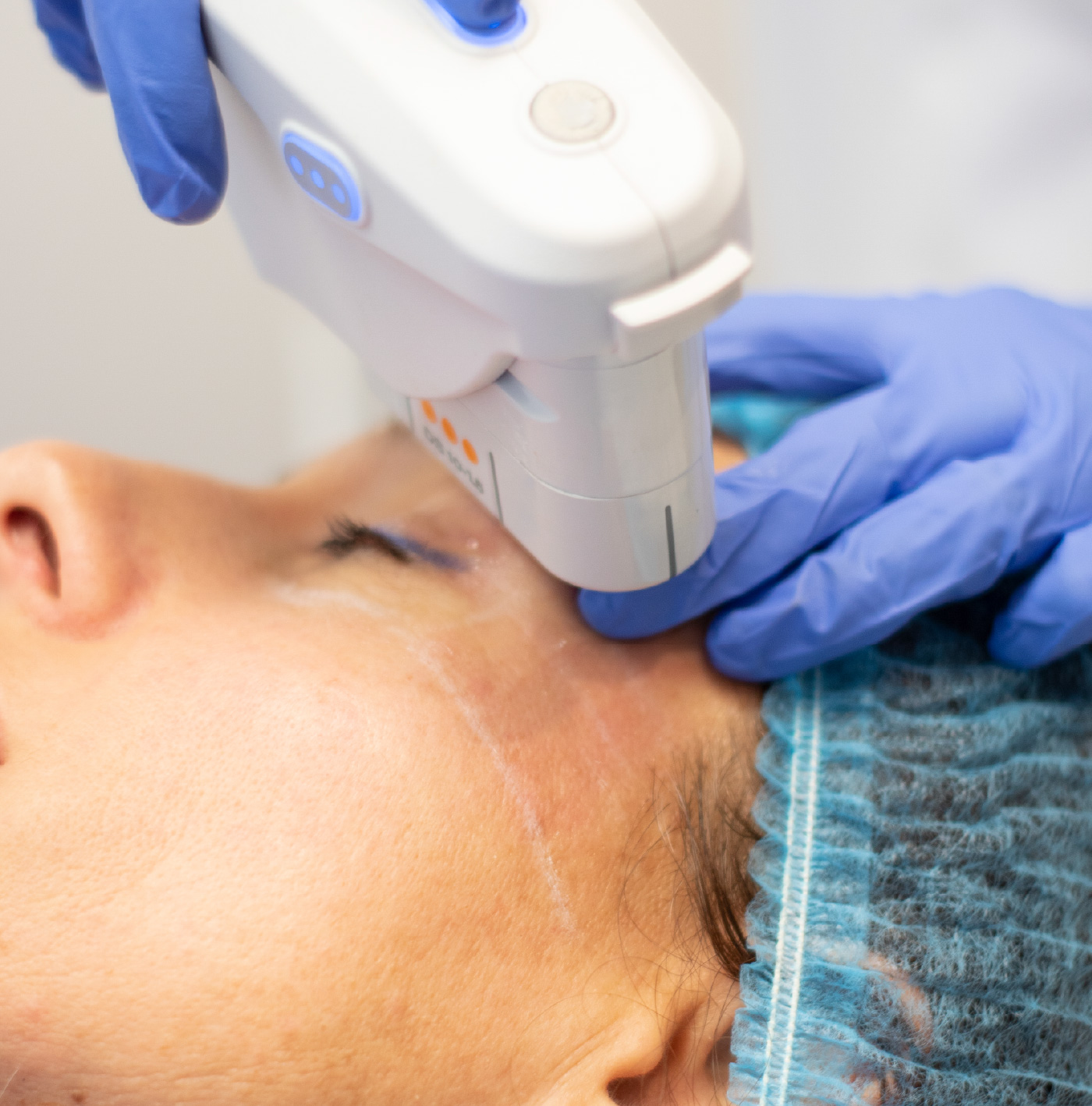 Lifting facial con tecnología