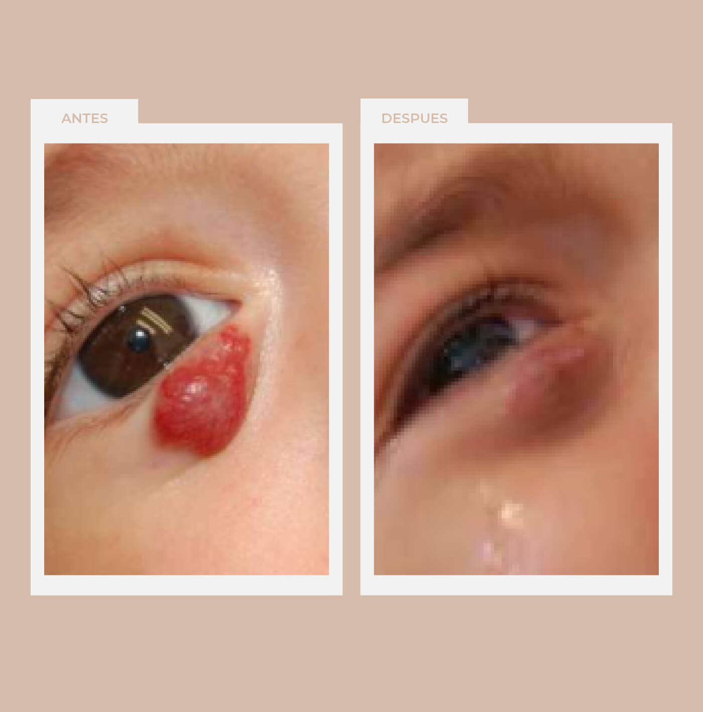 Hemangioma infantil