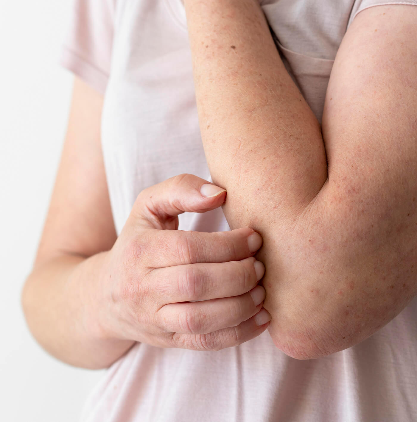 Dermatitis atópica