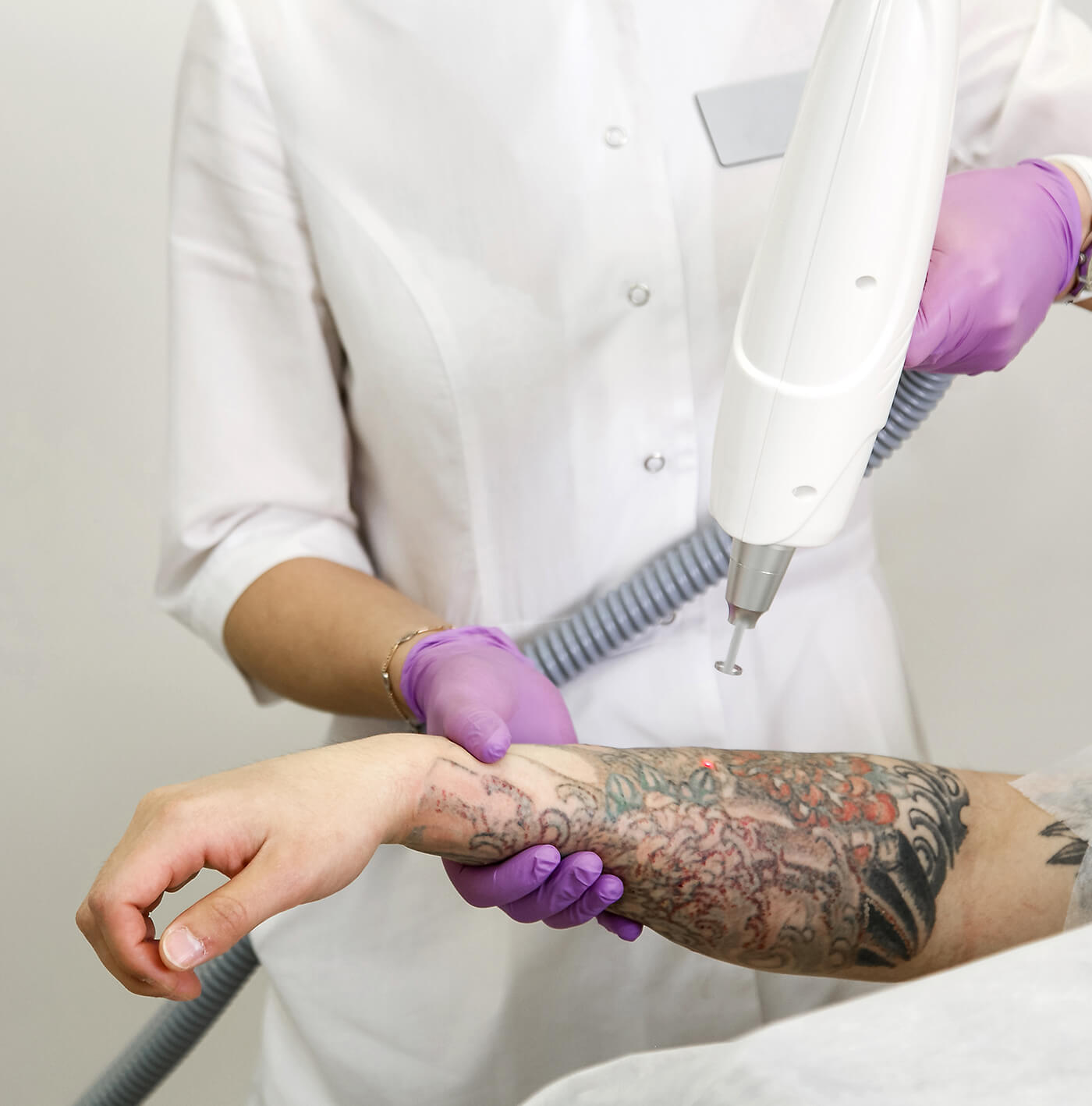 Eliminación de tatuajes