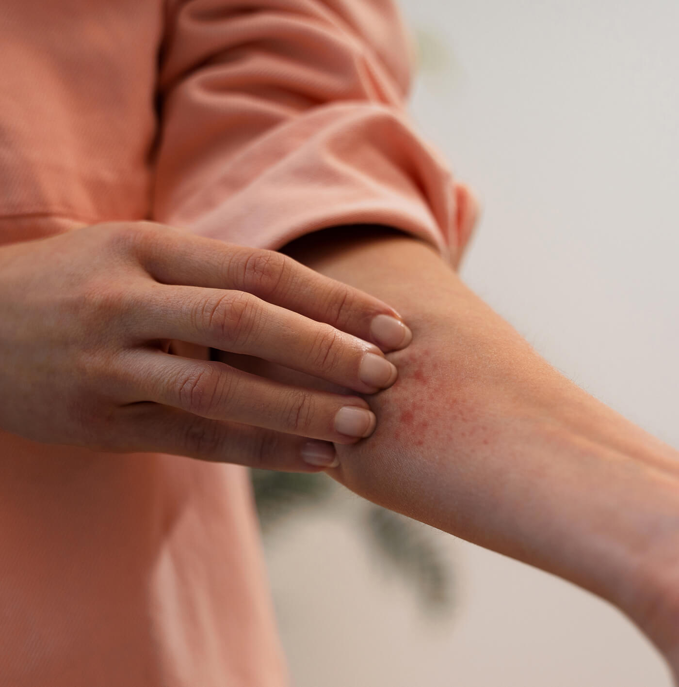 Dermatitis atópica