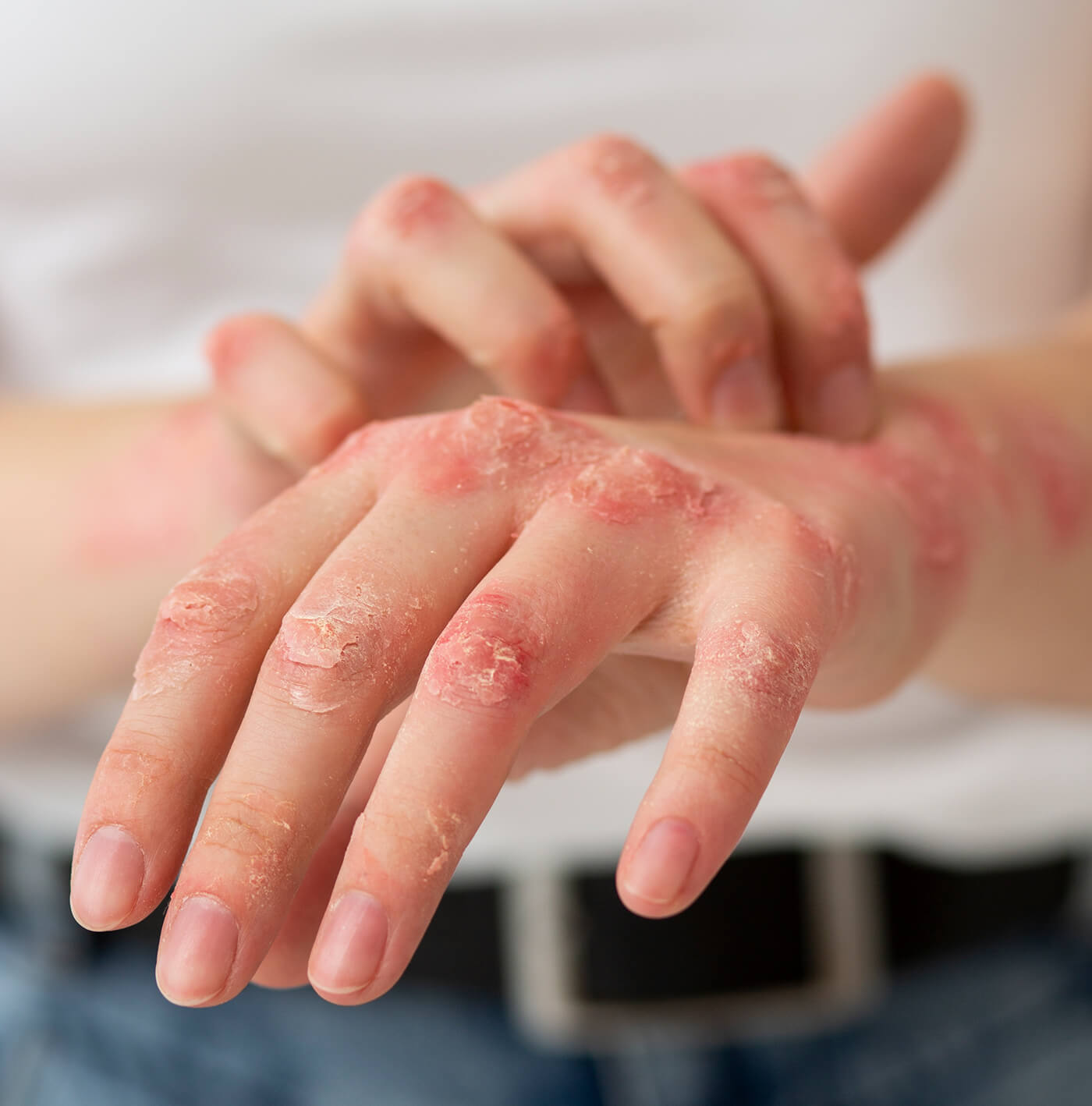 Psoriasis