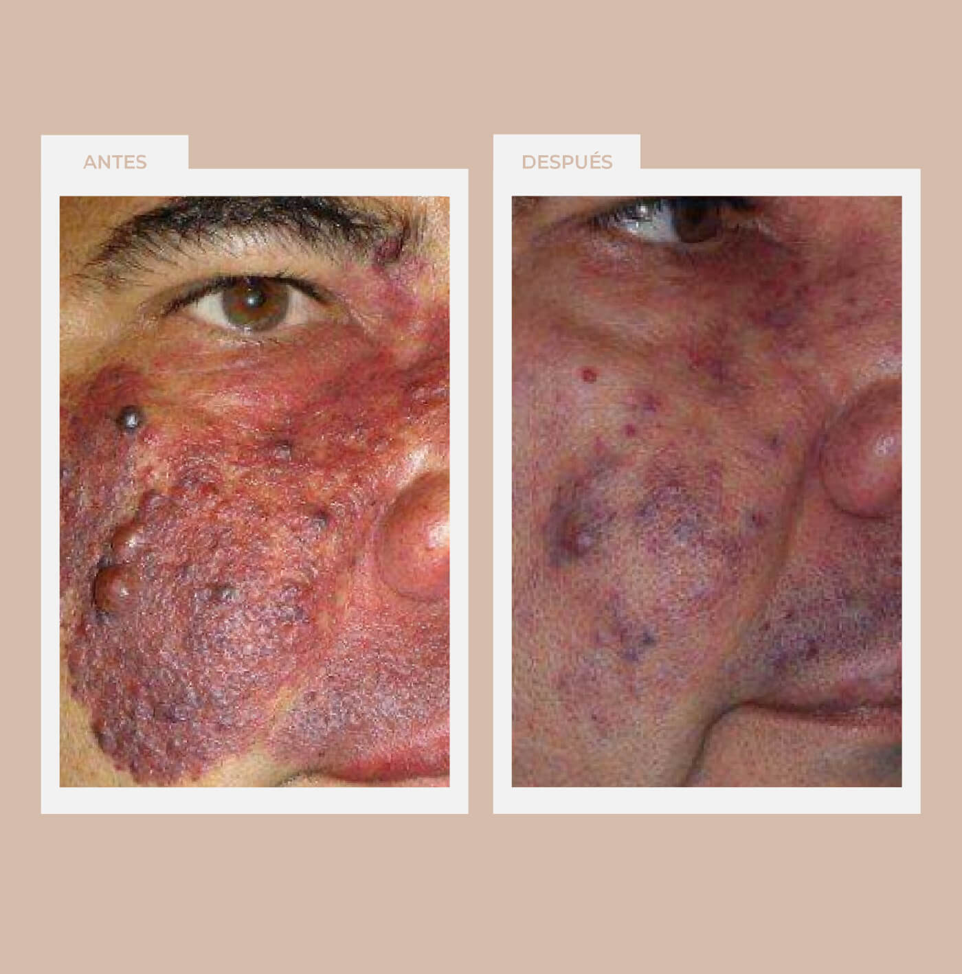 Tratamiento de una malformación vascular en una persona adulta
