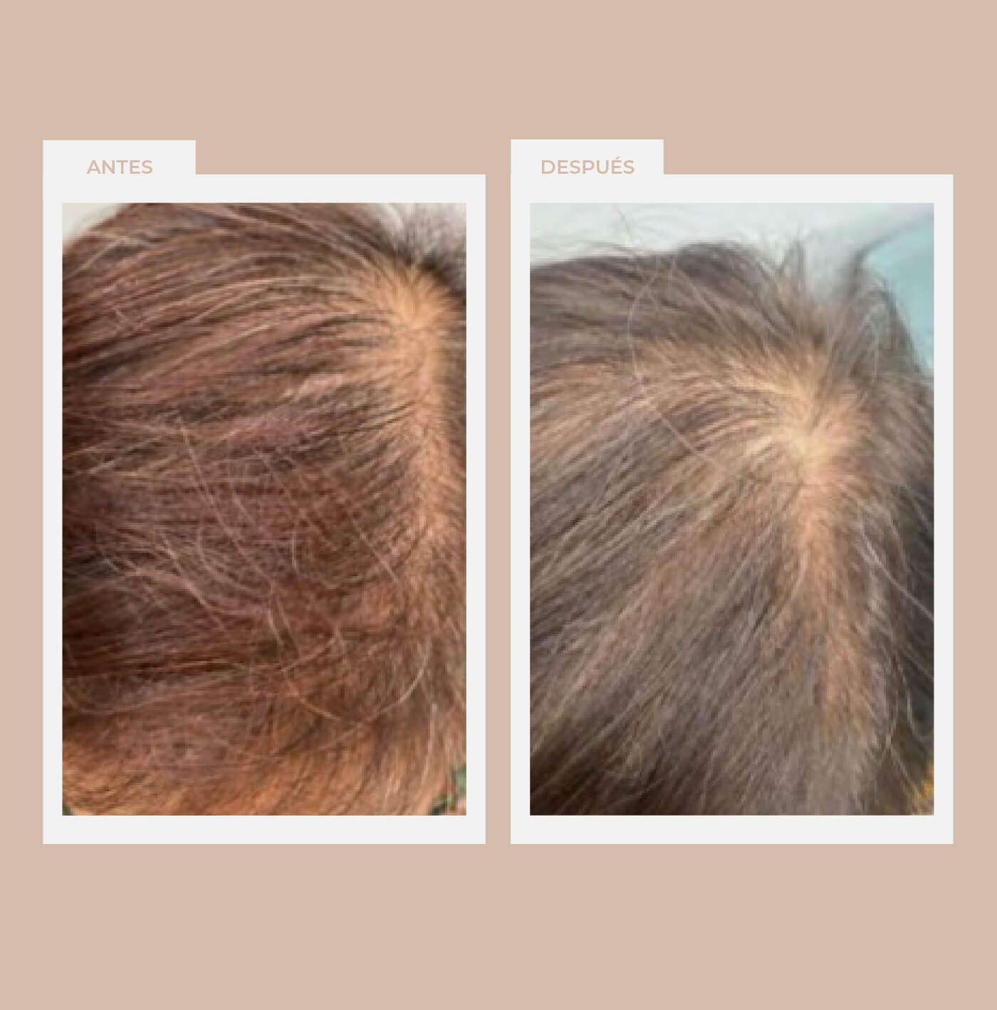 Alopecias (pérdida de cabello)