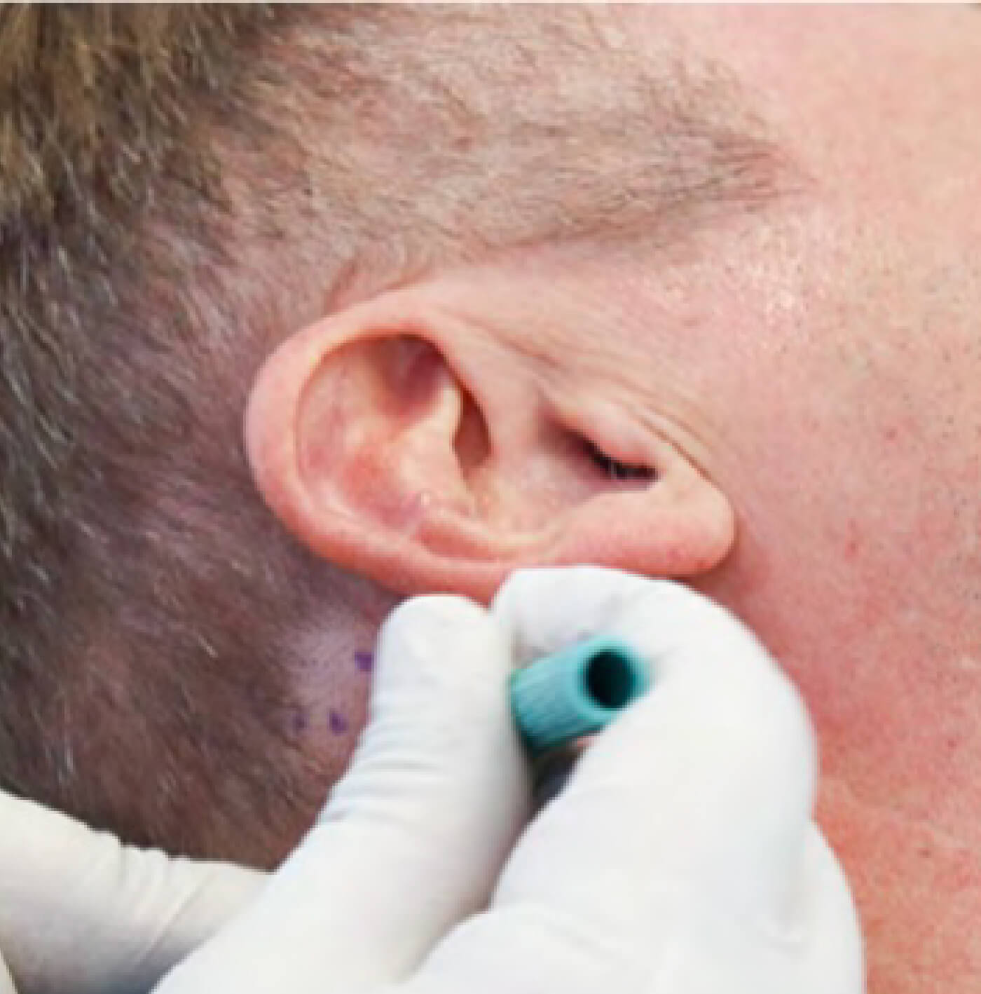 Alopecias (pérdida de cabello)
