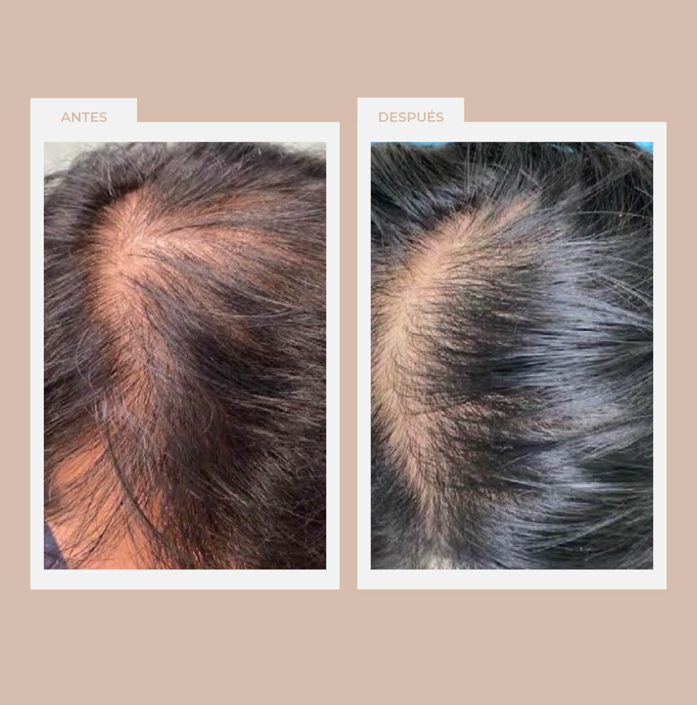 Alopecias (pérdida de cabello)