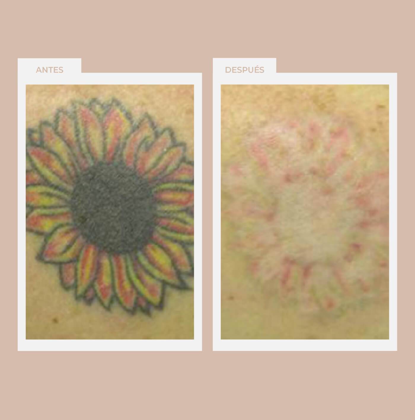 Eliminación de tatuajes