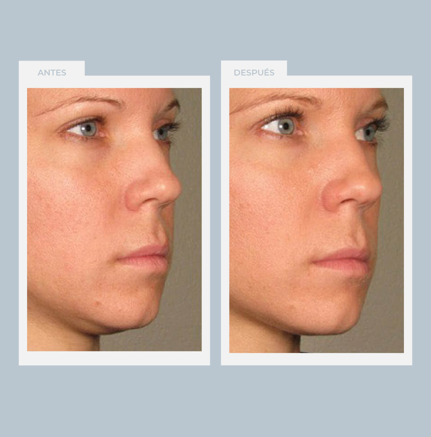 Flacidez de rostro y papada