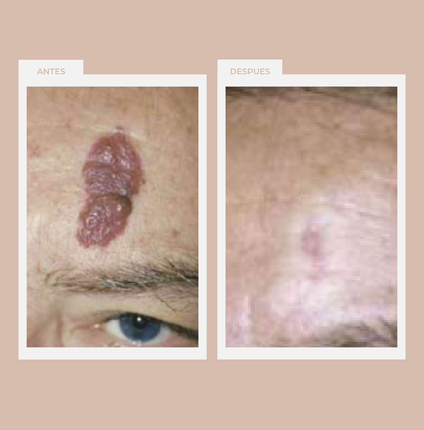 Hemangiomas